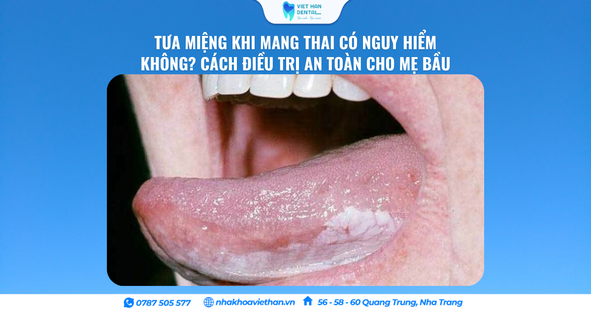 Tưa Miệng Khi Mang Thai