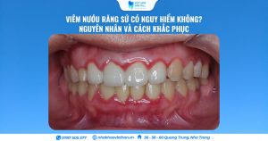 viêm nướu răng sứ