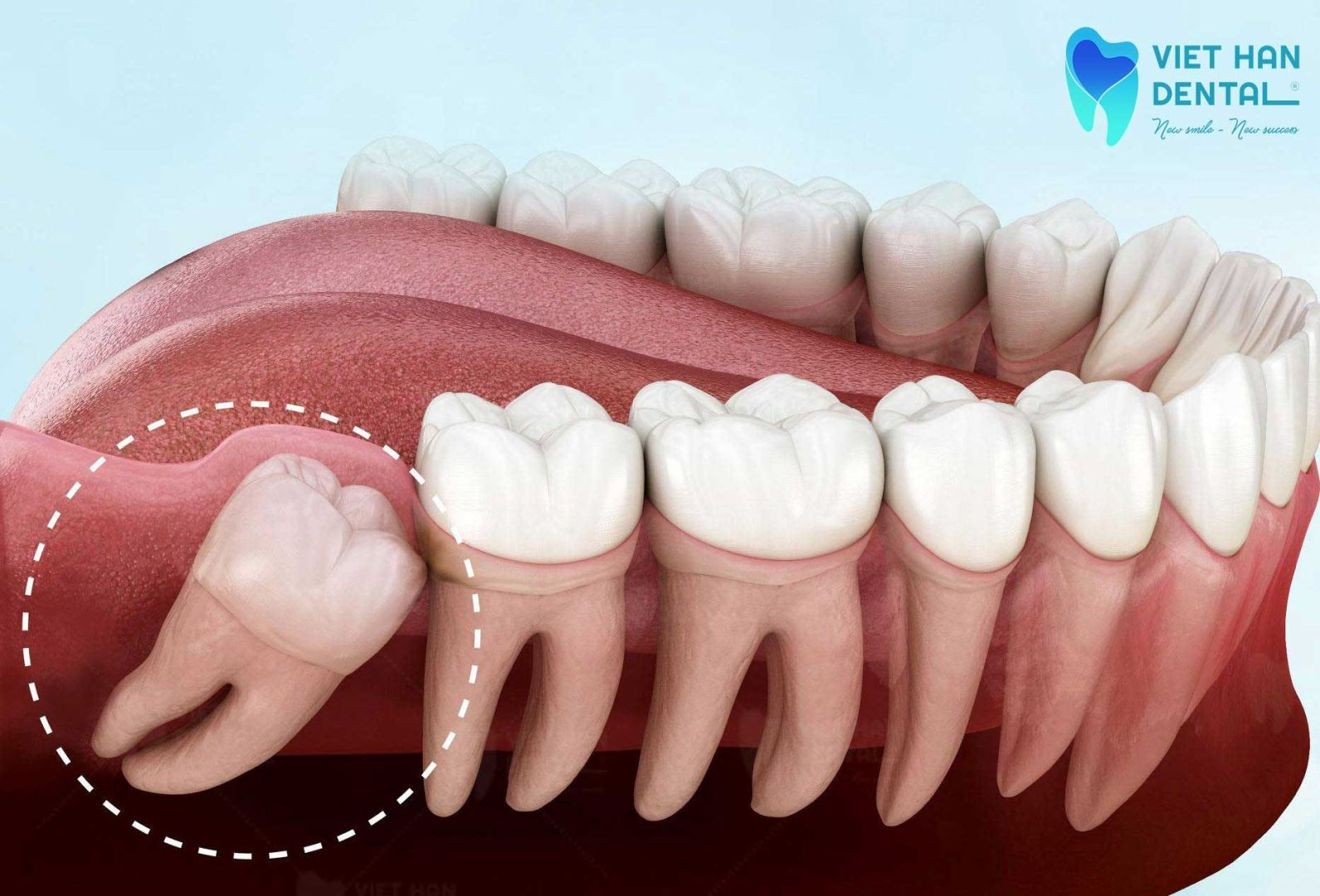 Răng khôn mọc lệch ảnh hưởng đến răng số 7