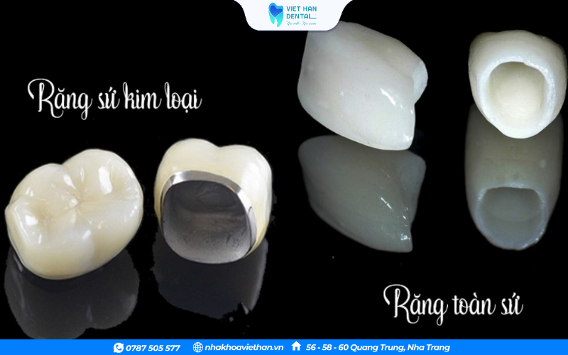 Răng sứ toàn sứ và răng sứ kim loại
