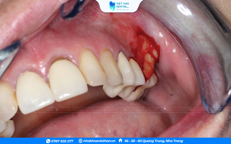 vi khuẩn phát triển.