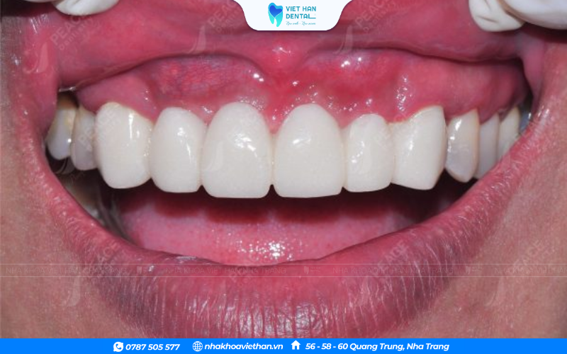 viêm nướu răng sứ