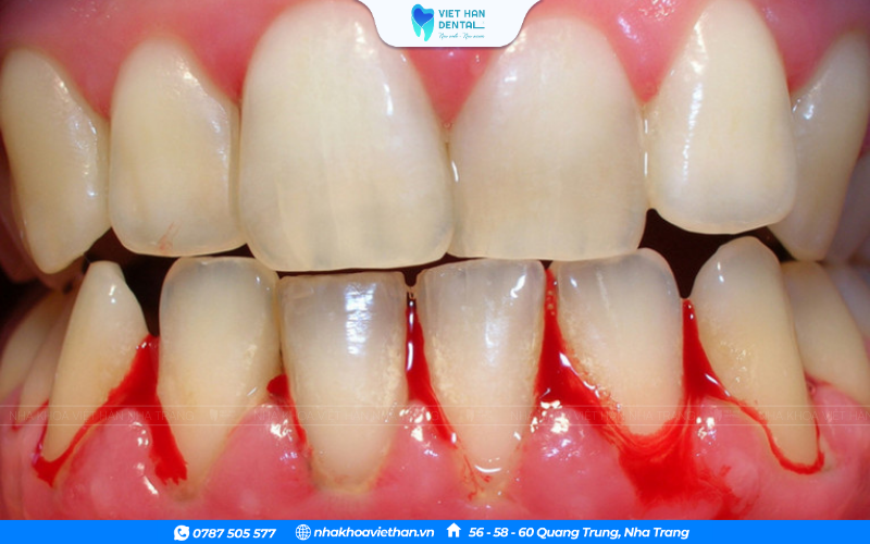 viêm nướu răng sứ