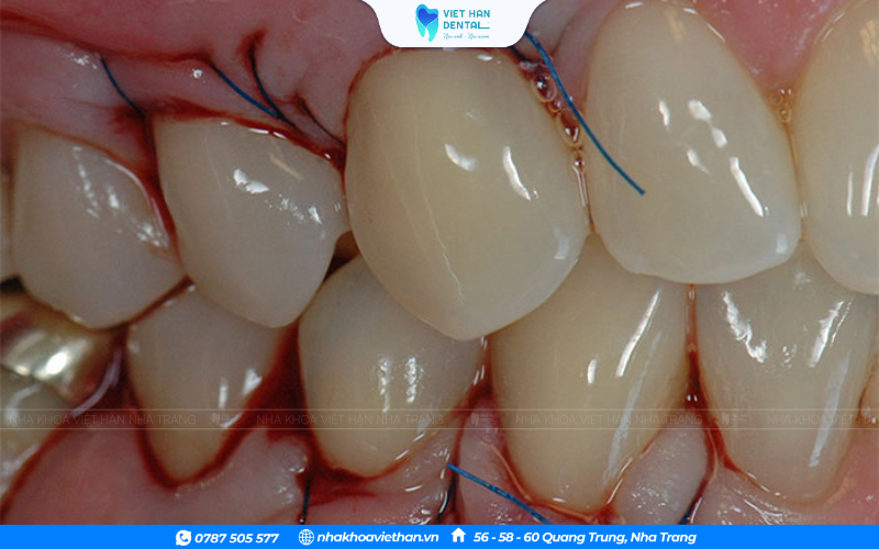 Phẫu thuật cắt lợi hoặc ghép lợi