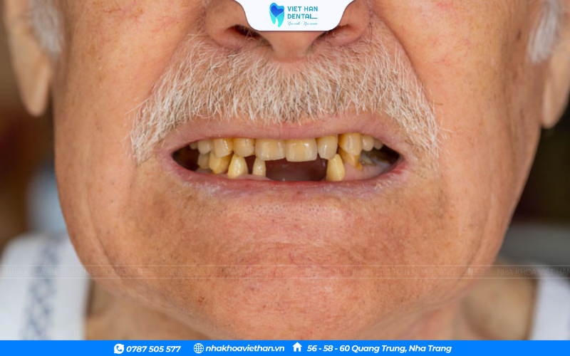 Răng Sứ (21)