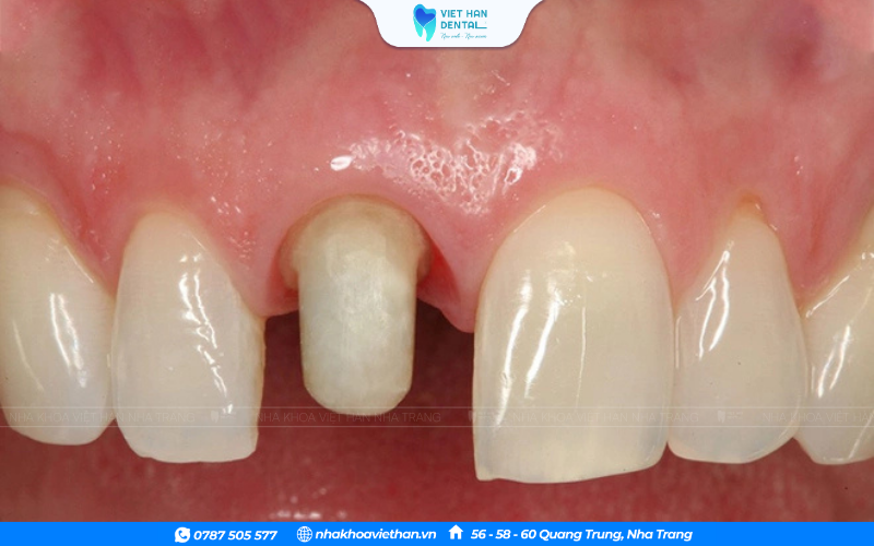 Răng Sứ (23)