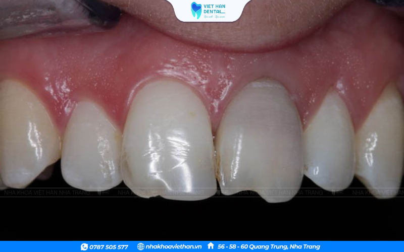 Răng bị tổn thương