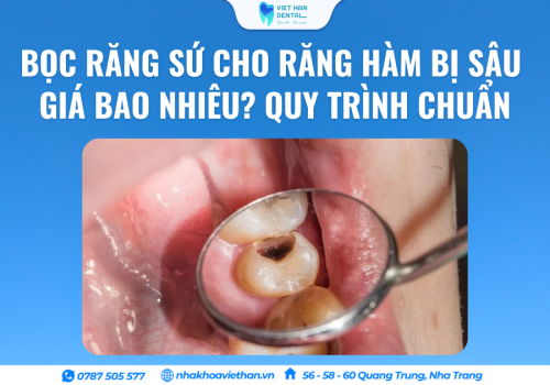 Bọc Răng Sứ Cho Răng Hàm Bị Sâu Giá Bao Nhiêu? Quy Trình Chuẩn