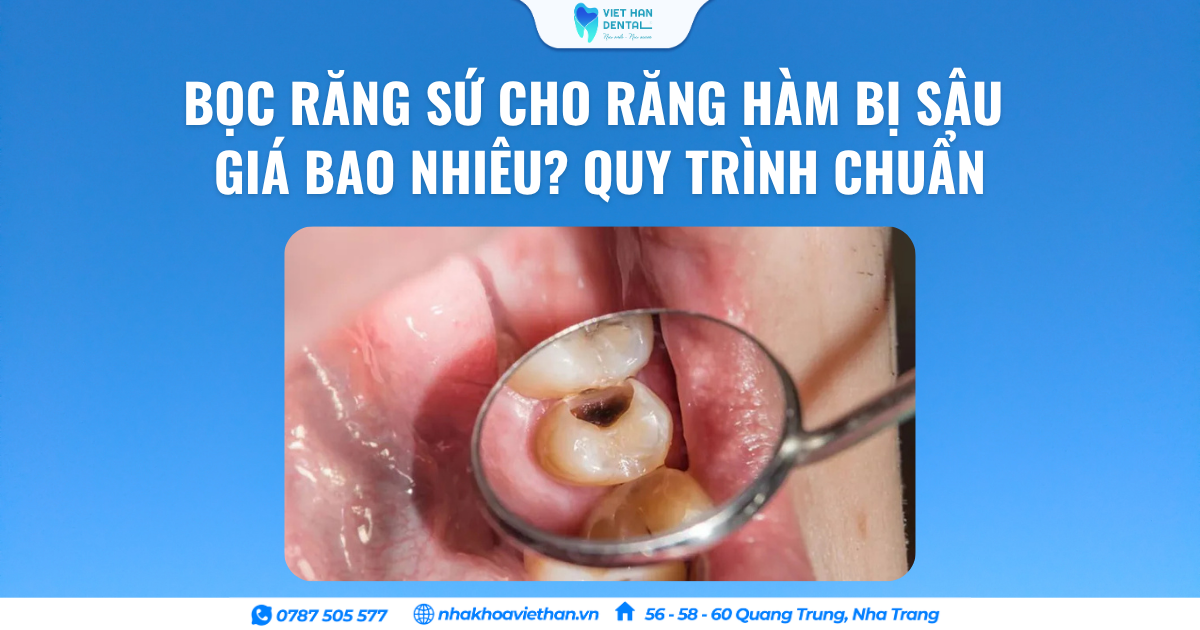 Bọc Răng Sứ Cho Răng Hàm Bị Sâu Giá Bao Nhiêu? Quy Trình Chuẩn