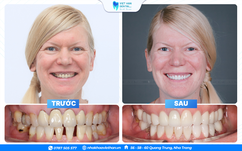 Khách Hàng Bọc Sứ (1)