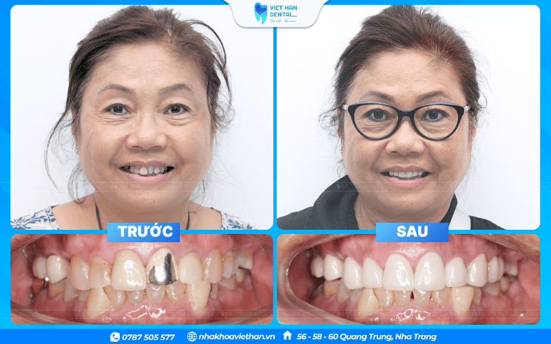 Khách Hàng Bọc Sứ (2)