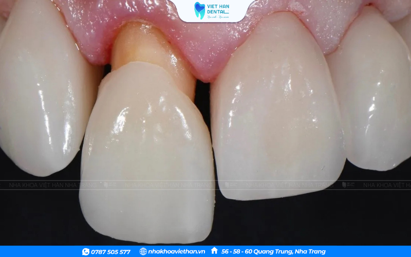 Nếu chỉ bọc một vài chiếc, hãy chọn màu giống răng thật.