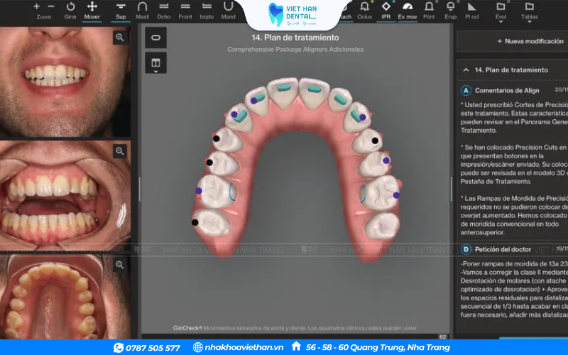 Clincheck giúp bạn biết chính xác nụ cười của mình sẽ thay đổi ra sao qua từng tuần đeo khay