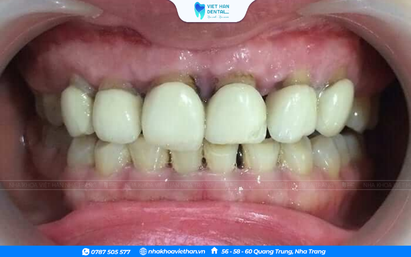 Sau khi bọc răng sứ lâu năm, mô nướu có thể bị tụt hoặc teo dần theo tuổi tác.