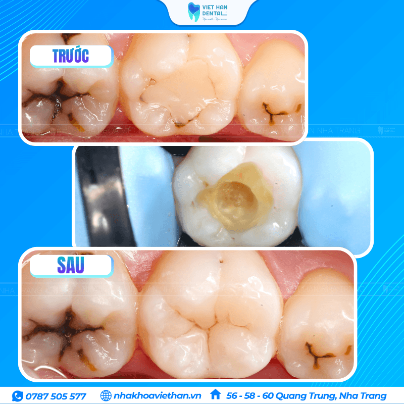 Trám răng hàm số 6 bị sâu