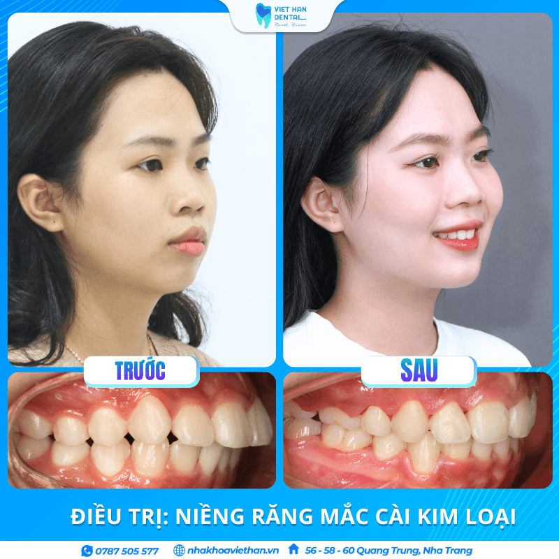 Khách hàng Huyền Diệu trước và sau khi niềng răng tại Nha khoa Việt Hàn