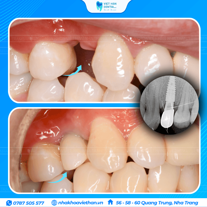 Trồng răng Implant đơn lẻ khôi phục răng đã mất