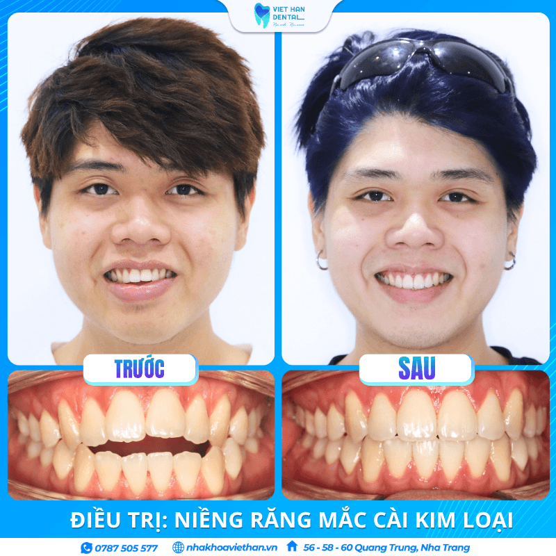 Khách hàng Thiên Huy trước và sau khi niềng răng tại Nha khoa Việt Hàn