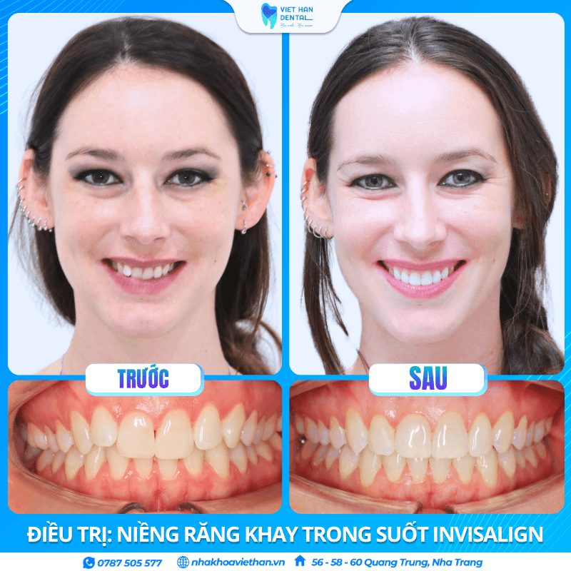 Khách hàng Caitlin Frewen trước và sau khi niềng răng tại Nha khoa Việt Hàn