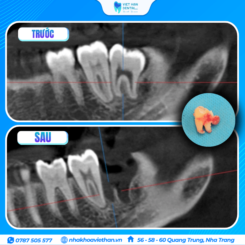 Khách hàng Quốc tế nhổ răng khôn tại Nha khoa Việt Hàn