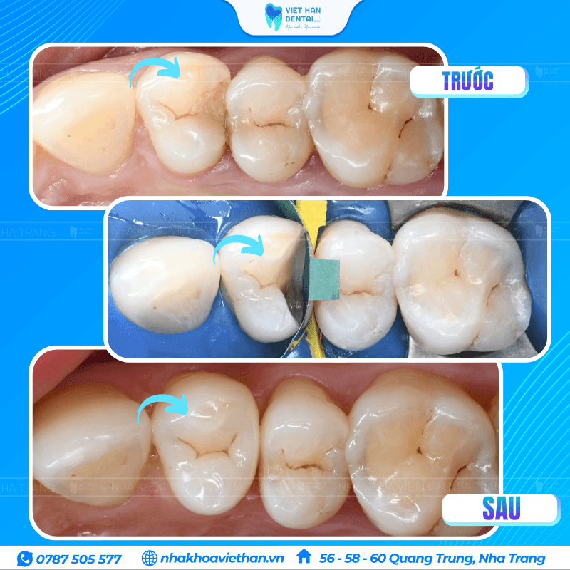 Chị Clara trước và sau khi trám răng