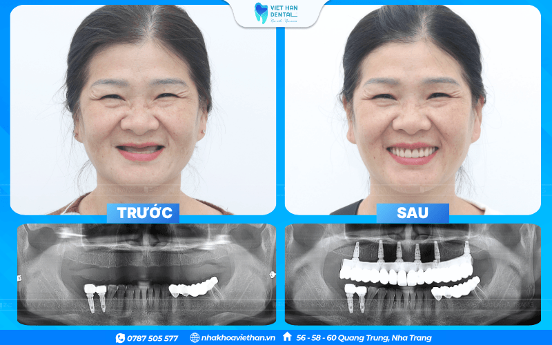 Khách hàng Hoàng Yến trước và sau khi trồng răng Implant tại Nha khoa Việt Hàn 