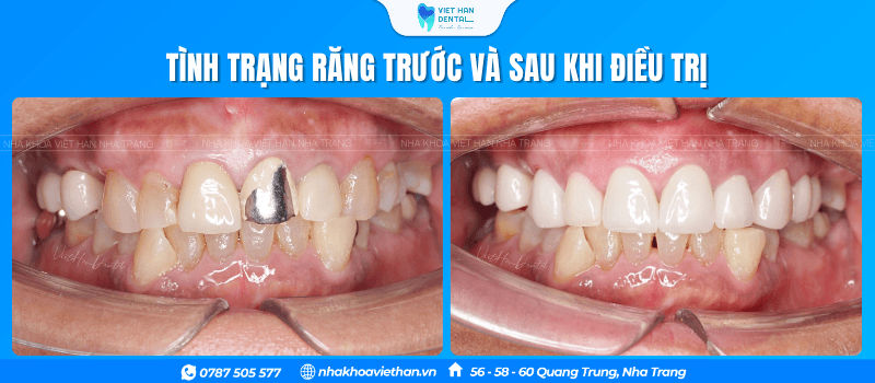 Tình trạng răng của cô Lâm Kim Ngọc trước và sau khi điều trị tại Nha khoa Việt Hàn