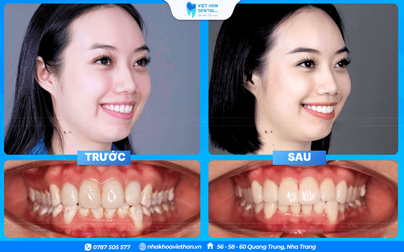 Lựa chọn địa chỉ nhoa uy tín tại Nha Trang để làm răng sứ an toàn, hiệu quả