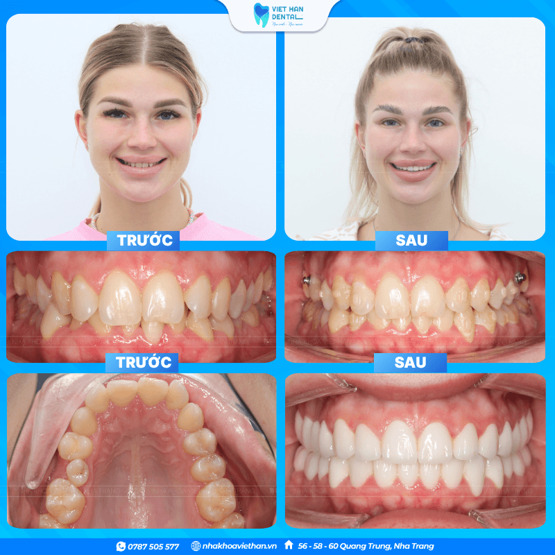 Patients undergoing orthodontic treatment and porcelain veneer placement in Vietnam.