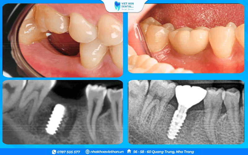 Trụ Implant có thể dùng được 20 -25 năm và có thể lâu hơn