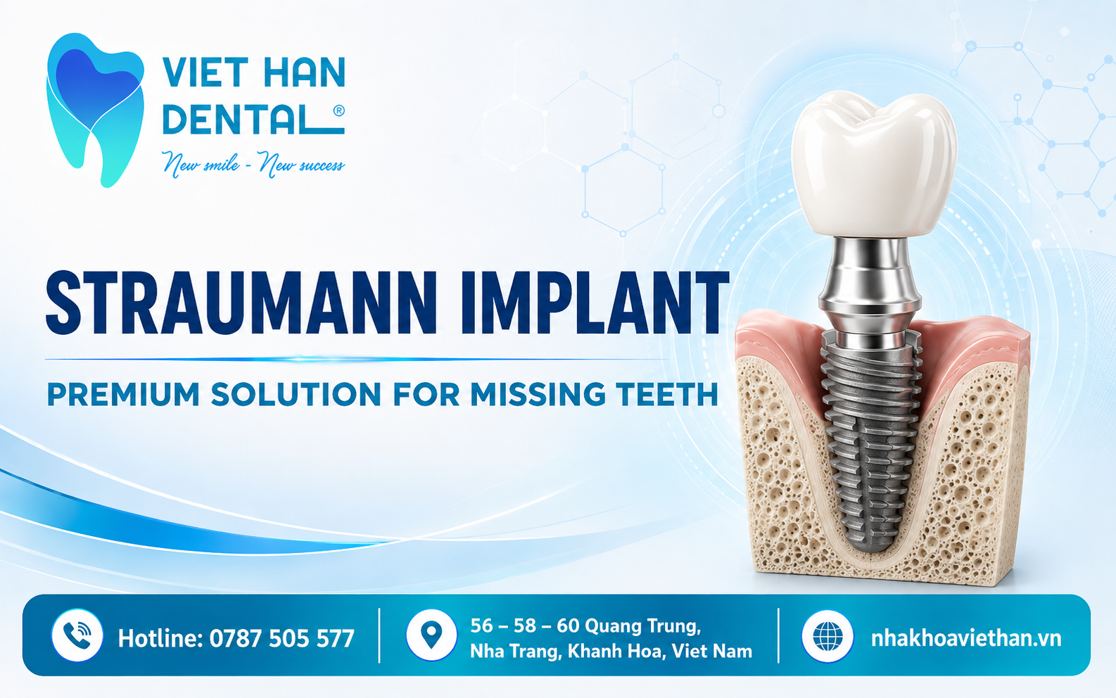 Straumann Implant